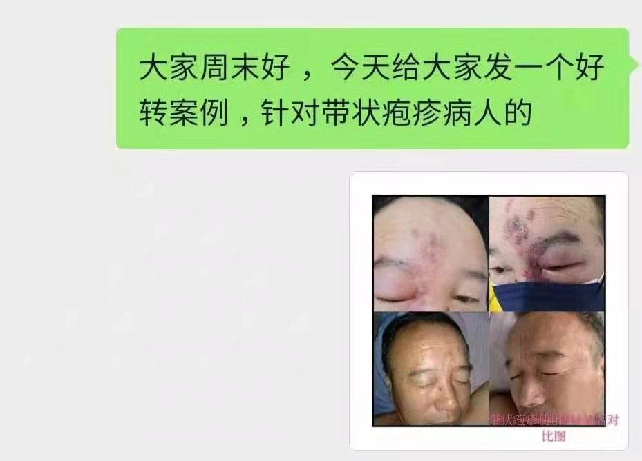 带状疱疹 (2).jpg